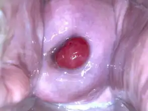 宫颈息肉知多少