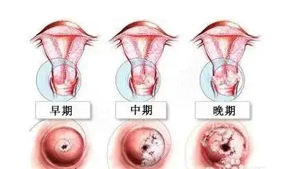 曲姿从阴道炎到宫颈癌的全过程