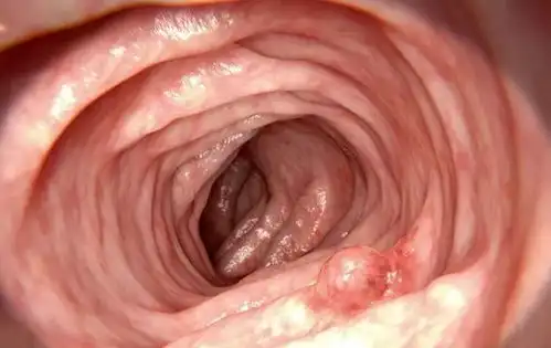 体检发现肠息肉胃息肉声带息肉胆囊息肉鼻息肉宫颈息肉,怎么办