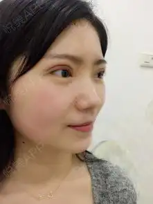你不改变你永远不知道自己有多美,闺蜜也说我五官不错...双眼皮悦美整形