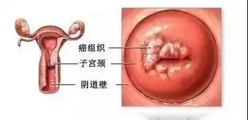 说摘就摘的宫颈息肉