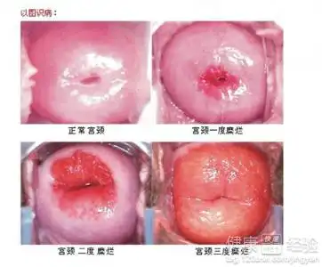 宫颈糜烂和宫颈息肉通过什方法么治疗