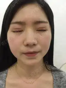 你不改变你永远不知道自己有多美,闺蜜也说我五官不错...双眼皮悦美整形